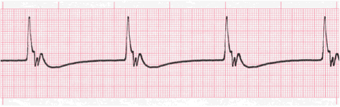 Ventricular Rhythms