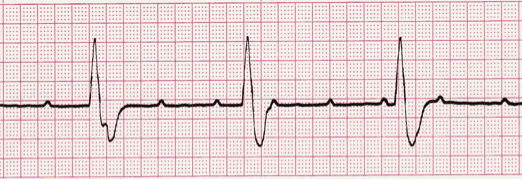 Third Degree Atrioventricular Block