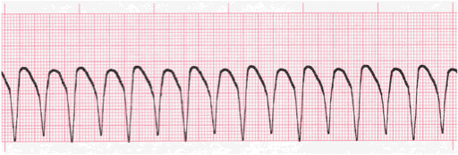 Ventricular Tachycardia